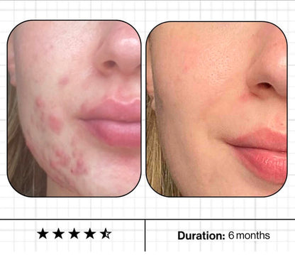 Skin Accumax™
